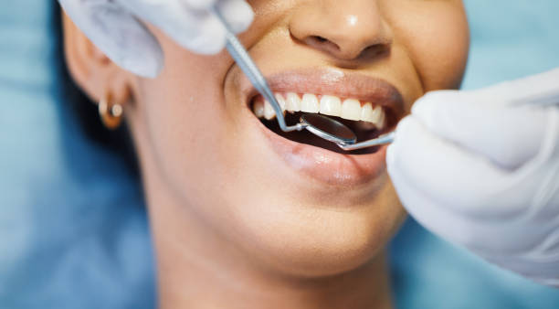 Best Knocked-Out Tooth (Avulsed Tooth) Treatment in Fort Lee, VA